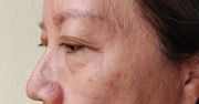 Podstępny przeciwnik. Objaw raka płuc można zauważyć na twarzy