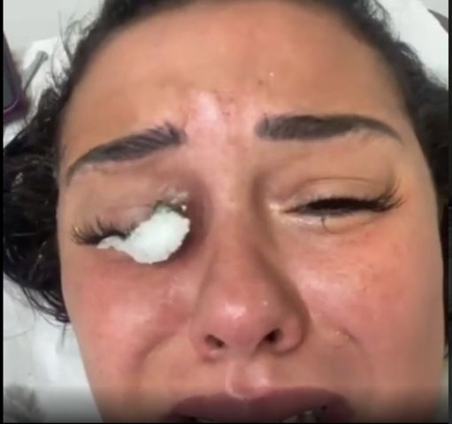 Chciała przedłużyć rzęsy. Kosmetyczka uszkodziła jej oko do tego stopnia, że omal nie straciła wzroku