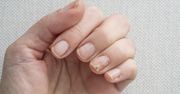 Przyjrzyj się, zanim wykonasz manicure. Ten objaw raka zobaczysz gołym okiem