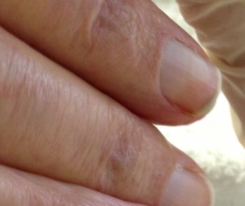 Nie lekceważ tych zmian. Paznokcie mogą ujawniać poważne choroby