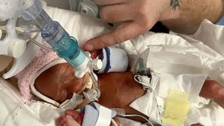 Bliźniaczki urodziły się w 25. tygodniu ciąży