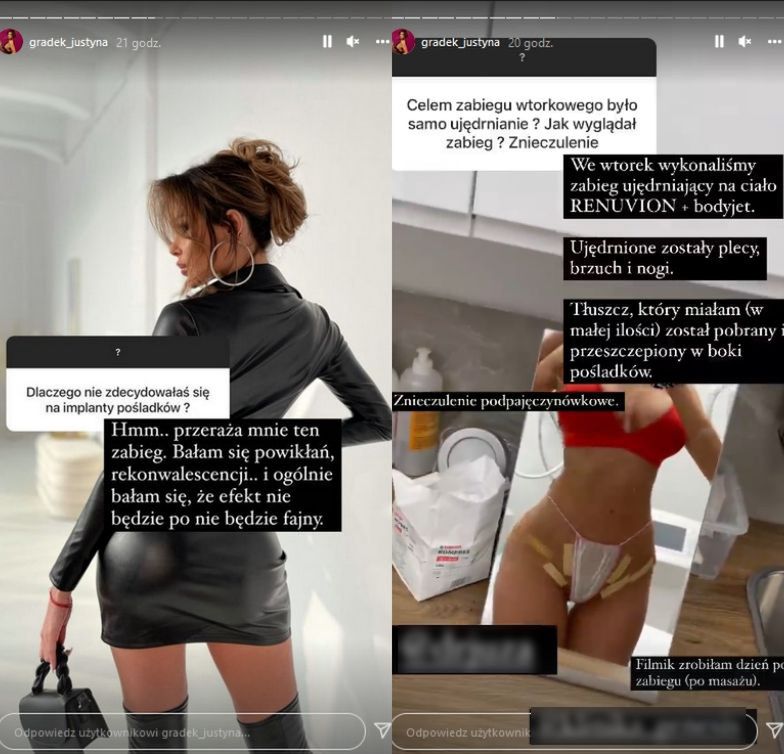 Justyna Gradek zachwala zabieg na pośladki