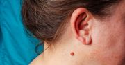 Brodawki na szyi – skąd się biorą i jak się ich pozbyć?