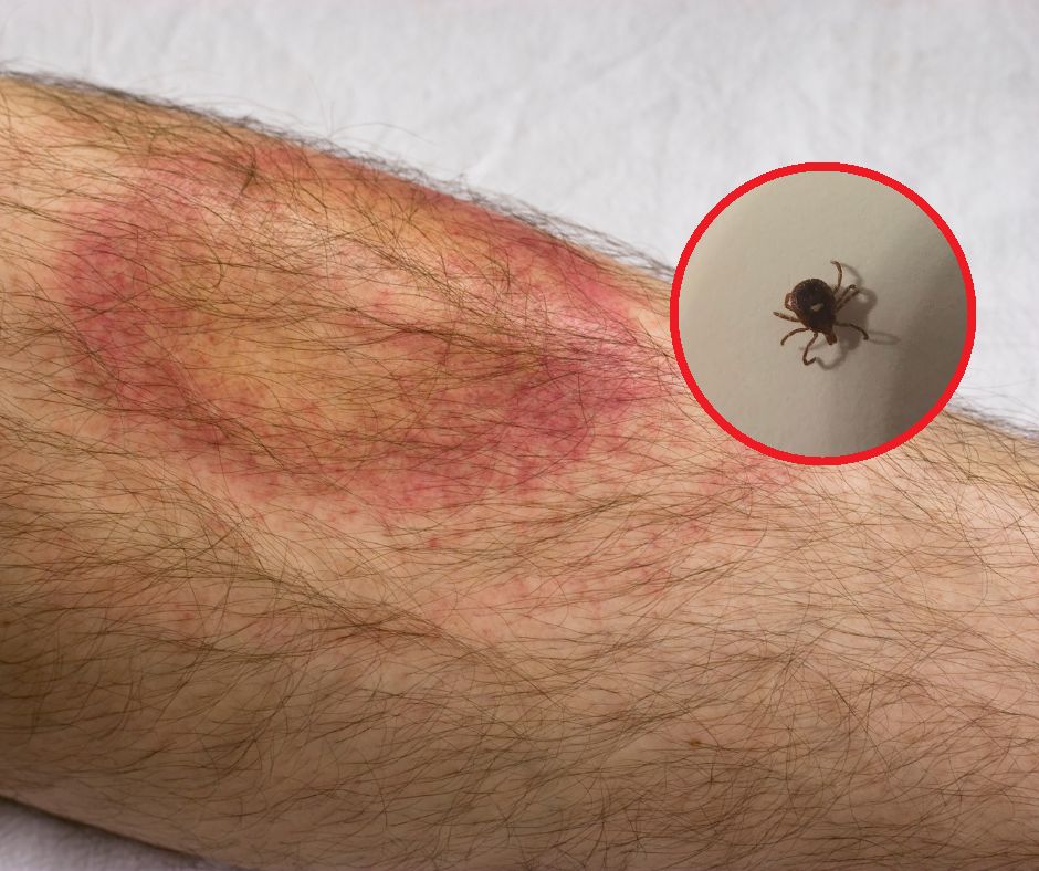 Kleszcze atakują. Dramatyczny wzrost przypadków boreliozy