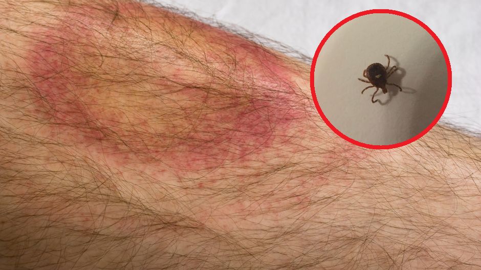 Prawie 5 tys. przypadków boreliozy w Polsce. Wzrost niemal o połowę