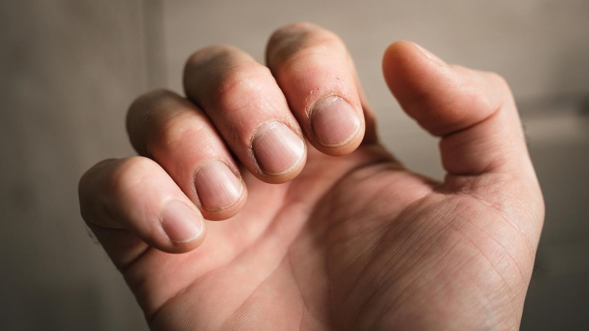 Wygląd palców może zdradzać groźną chorobę. Czym jest strzelający palec?