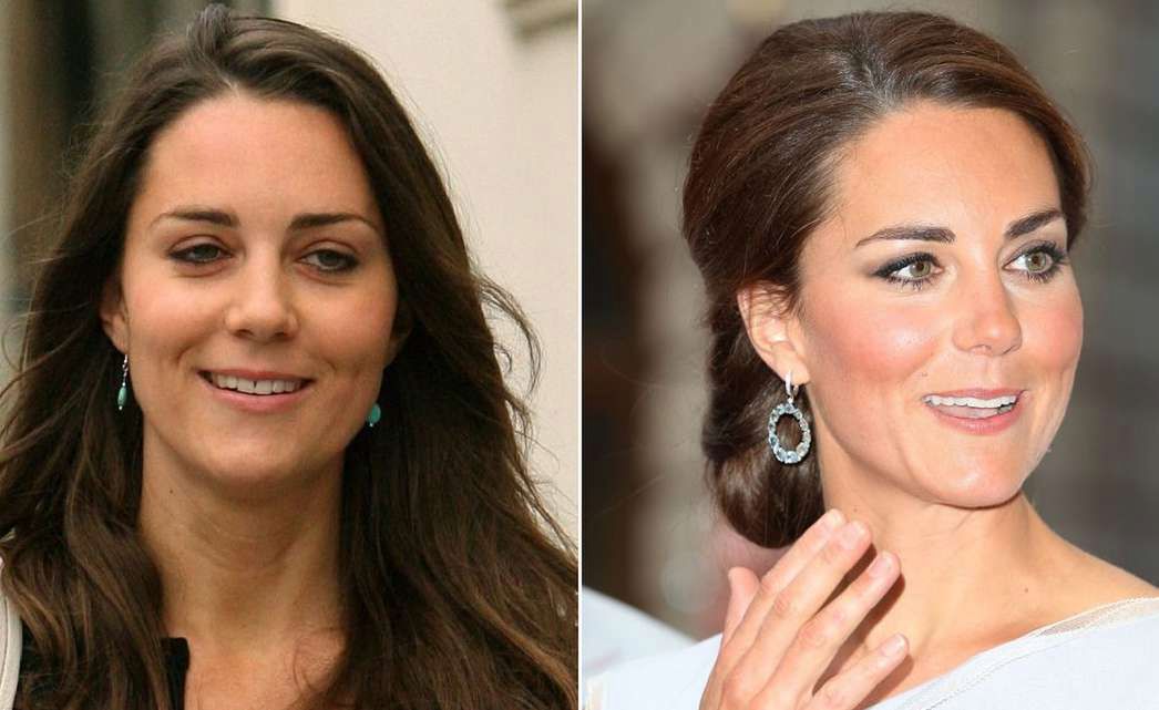 Księżna Kate przed i po operacji plastycznej