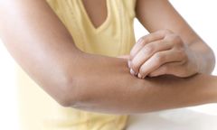 Ugryzienie swędzi i piecze? Ale to nie komar. Poznaj kuczmana