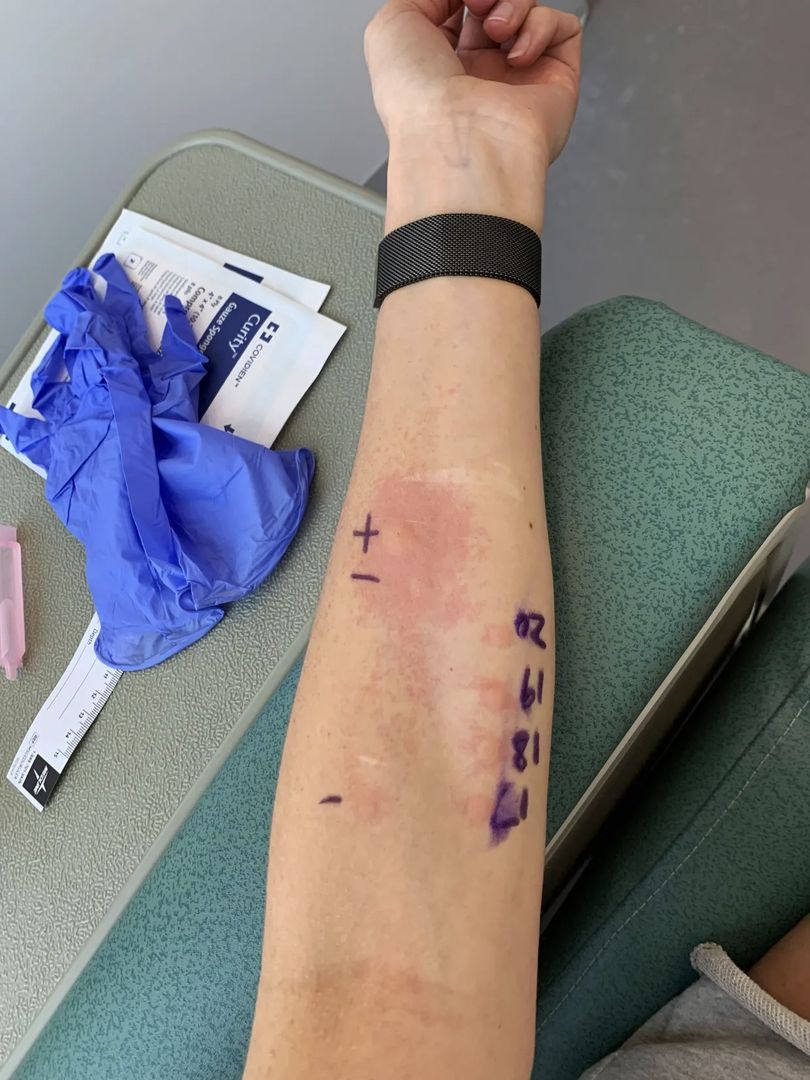 Alergia powoduje u niej wysypkę i zaczerwienienia
