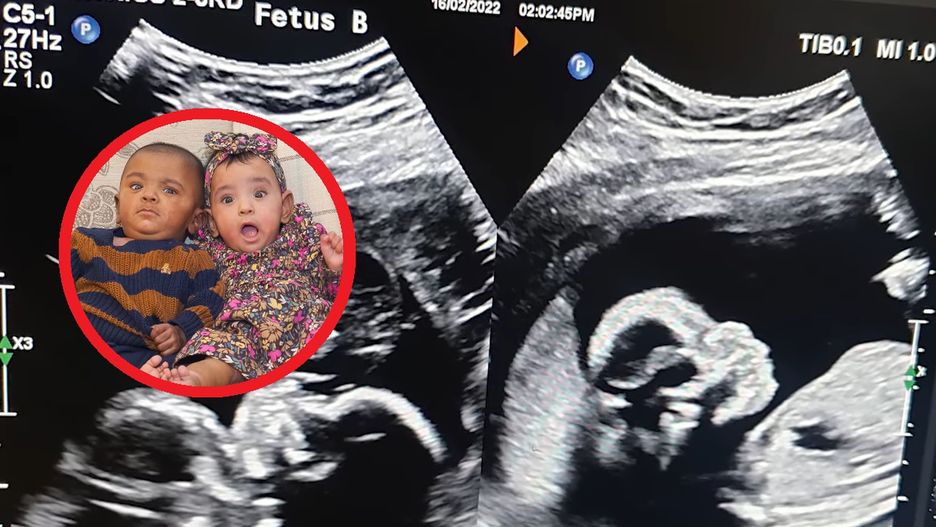 Kiedy się urodziły, lekarze nie dawali im żadnych szans. Bliźniaki trafiły do Księgi Rekordów Guinnessa