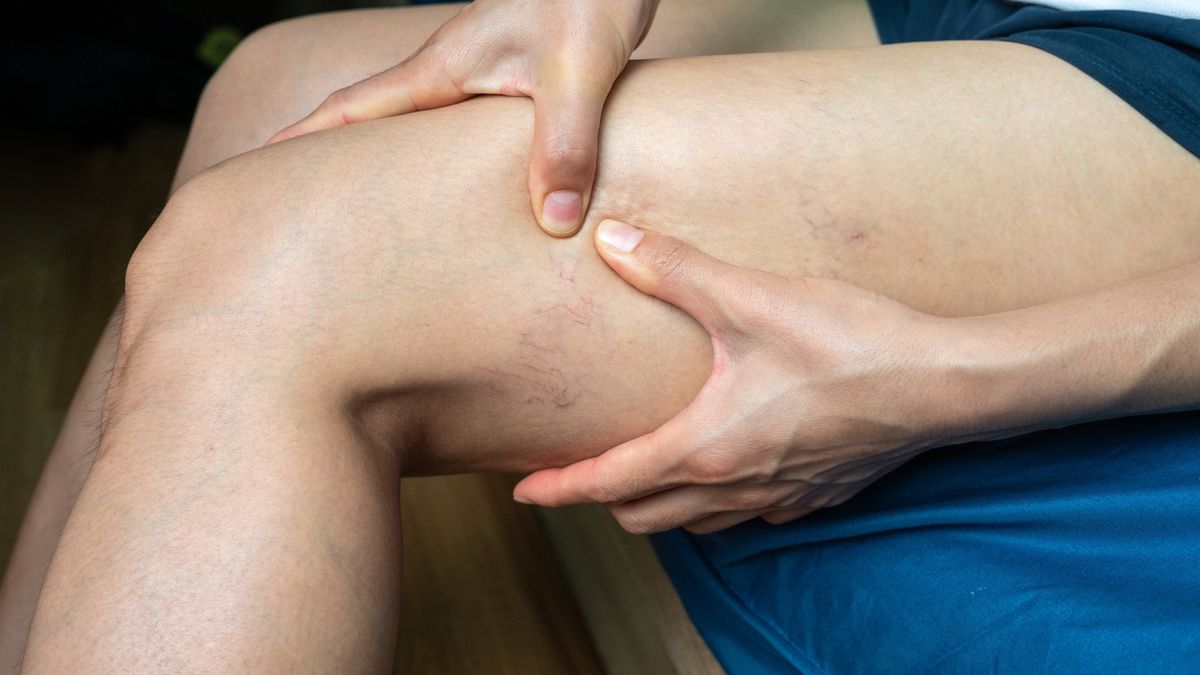 Cropped shotview of woman having spider veins occur on her thigh. In some cases, severe varicose veins can lead to serious health problems, such as blood clots.
Spider veins and Varicose veins are a common condition caused by weak or damaged vein walls and valves.
Boy_Anupong