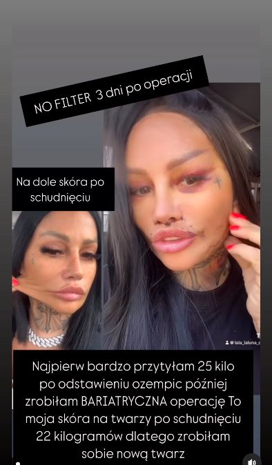 Laluna pokazała się 3 dni po operacji