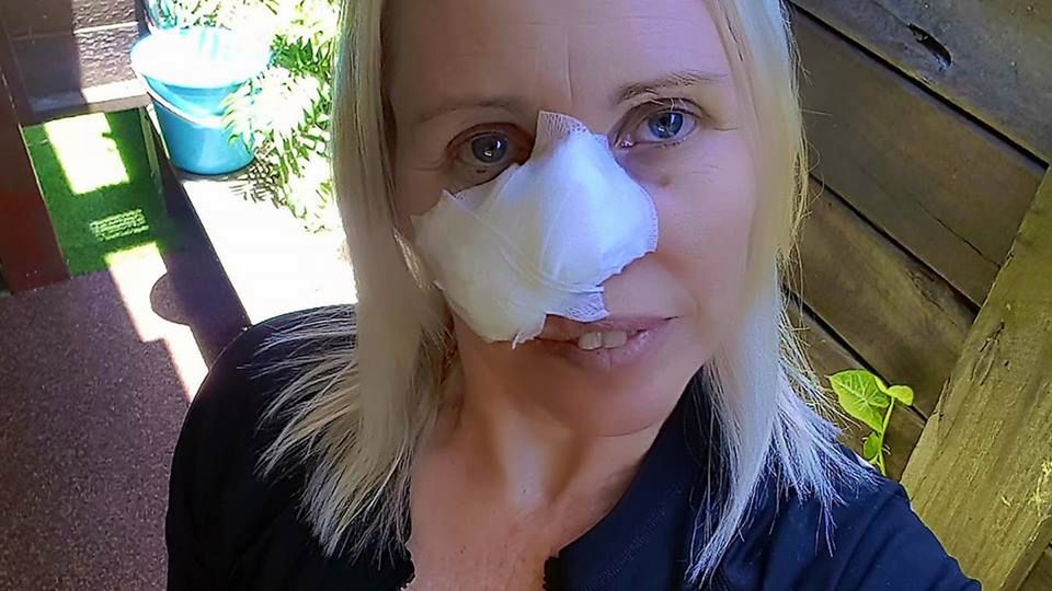 Narelle walczyła z rakiem skóry