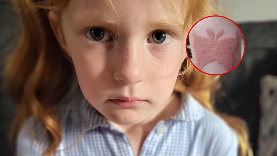Tatuaż okazał się "blizną na całe życie". Matka 7-latki przestrzega rodziców