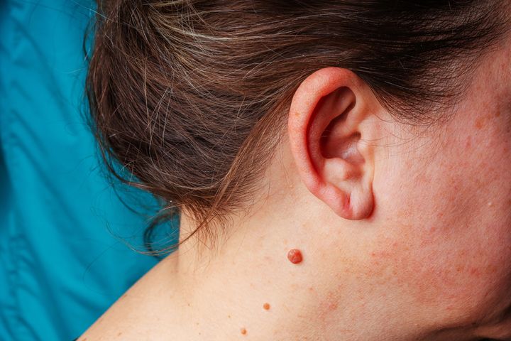Brodawki na szyi to zmiany skórne wywołane wirusem HPV