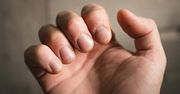 Wygląd palców może zdradzać groźną chorobę. Czym jest "strzelający palec"?