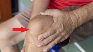 Zapchane tętnice widać gołym okiem. Zmiany wyprzedzają zawał i udar