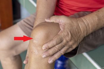 Zapchane tętnice widać gołym okiem. Zmiany wyprzedzają zawał i udar