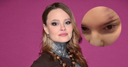 Monika Miller pokazała swoje RANY w sieci. "I jak się wytłumaczyć w pracy?"