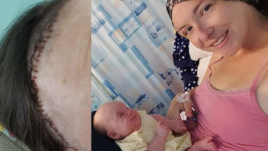 Myślała, że głowa boli ją przez ciążę. Badania wykryły guza mózgu