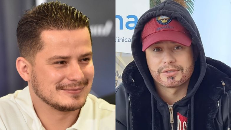 Rafał Collins pokazał efekty przeszczepu włosów na brodzie