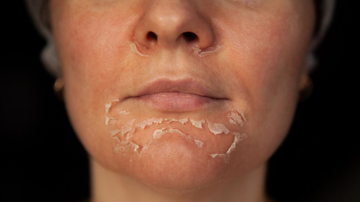 Złuszczanie naskórka możemy wykonać za pomocą różnego rodzaju pumeksów (skóra pięt) lub stosując specjalne peelingi