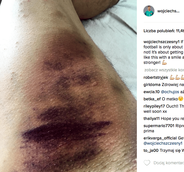 Jak wygląda noga Szczęsnego po zderzeniu z Laffertym?