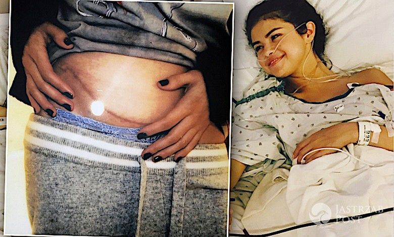 Szok! Selena Gomez zniknęła z mediów przez poważne problemy ze zdrowiem! Jest po przeszczepie nerki!