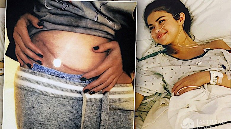 Selena Gomez przeszczep nerki, choroba