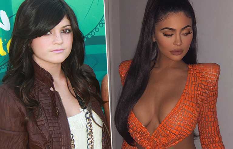 Kylie Jenner - przed i po operacji biustu
