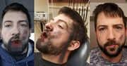 E-papieros eksplodował mu w ustach. Stracił 7 zębów