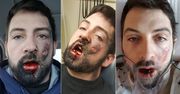 Stracił 7 zębów po tym, jak e-papieros wybuchł mu w twarz