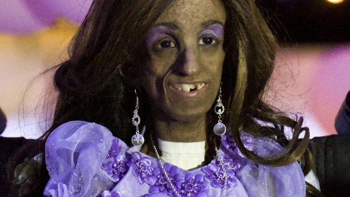 Colombian Magali Gonzalez Sierra, 15, smiles during her 15th birthday party in El Cabuyal, department of Valle del Cauca, Colombia, on January 16, 2016. Magali suffers from Hutchinson-Gilford progeria syndrome, a disease that causes premature aging in children, whose average lifespan is 13 years old. Magali's dream of celebrating her 15th birthday with a big party is today fulfilled with the help of neighbors and friends.  AFP PHOTO / LUIS ROBAYO