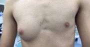 Urosła mu pierś. To efekt jedzenia fastfoodów