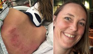 "Podkład" przed wakacjami na Teneryfie. Kobieta w śpiączce po solarium