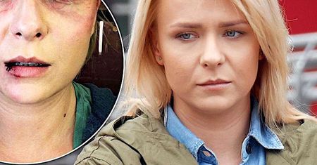 Aneta Zając brutalnie pobita! Pokazała przerażające zdjęcie posiniaczonej twarzy