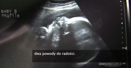 Wyjątkowy poród w USA