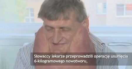 Usunęli pacjentowi 6-kilowego guza