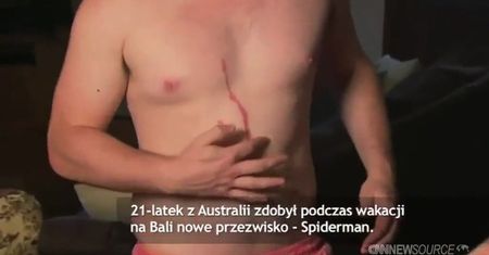 Pająk żył pod skórą człowieka