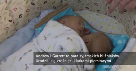Bliźnięta syjamskie o wspólnym sercu