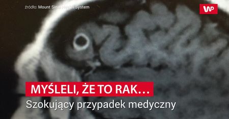 Myśleli, że to rak. Szokujący przypadek medyczny