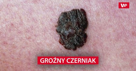 Groźny czerniak. Wyniki nowych badań nie są optymistyczne