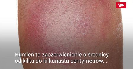 Jak rozpoznać boreliozę?