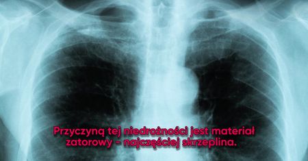 Zawał płuca. Może dawać nietypowe objawy