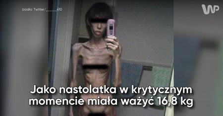 Nastolatka ważyła niecałe 17 kg. Opublikowała przerażające zdjęcia