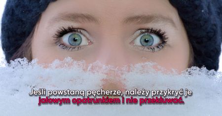 Odmrożenia – pierwsza pomoc