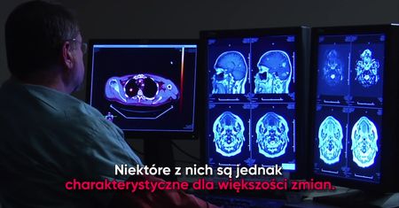 7 możliwych objawów guza mózgu