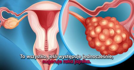 Jeden z najczęściej ignorowanych objawów raka jajnika