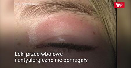 Plaster pod oczy wywołał alergię