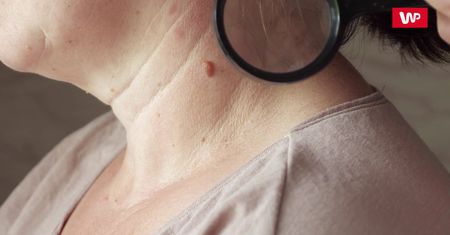 Znamiona a opalanie. Eksperci apelują do osób z pieprzykami przebywających na słońcu